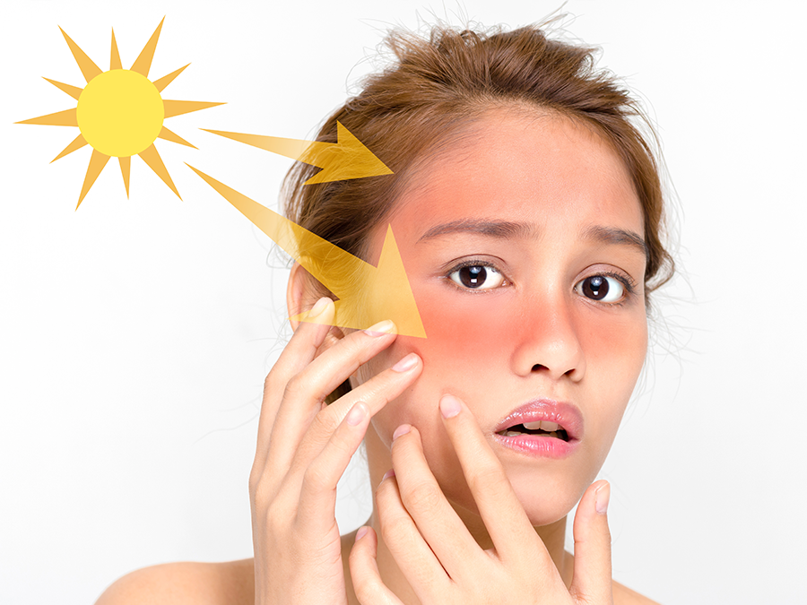 Home Remedies for Sunburn - American School of Natural Health